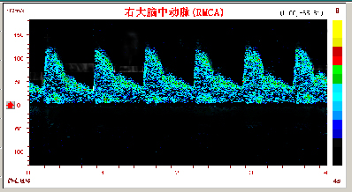 腦動脈硬化的TCD表現和常見疾病
