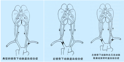 鎖骨下動脈盜血綜合征超聲TCD表現